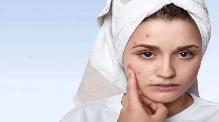 सिर्फ 7 दिनों में पाएं साफ और चमकदार त्वचा! किशोरावस्था की कील-मुंहासों को जड़ से खत्म करने वाला चमत्कारी स्किनकेयर रूटीनˈ