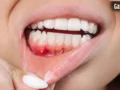 Gum Problems: क्या आपके मसूड़ों से भी आता है खून? भूलकर भी न करें नजरअंदाज, एक्सपर्ट ने बताए इसके बड़े कारण​