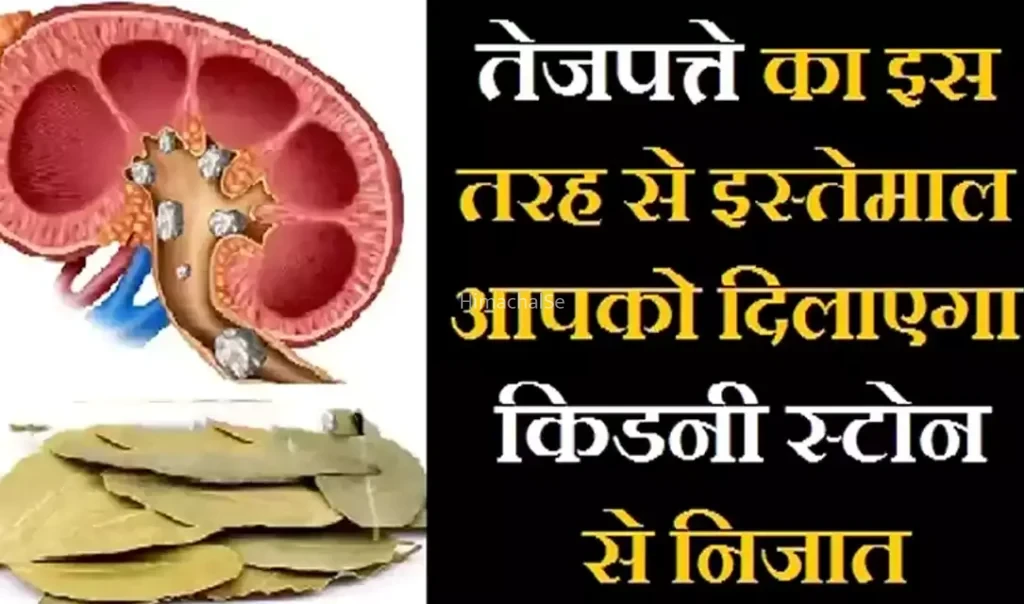 ​​तेजपत्ते का इस तरह से करेंगे इस्तेमाल तो आपको मिलेगा किडनी स्टोन से निजात, एक बार जरूर पढ़ें ये लेख
