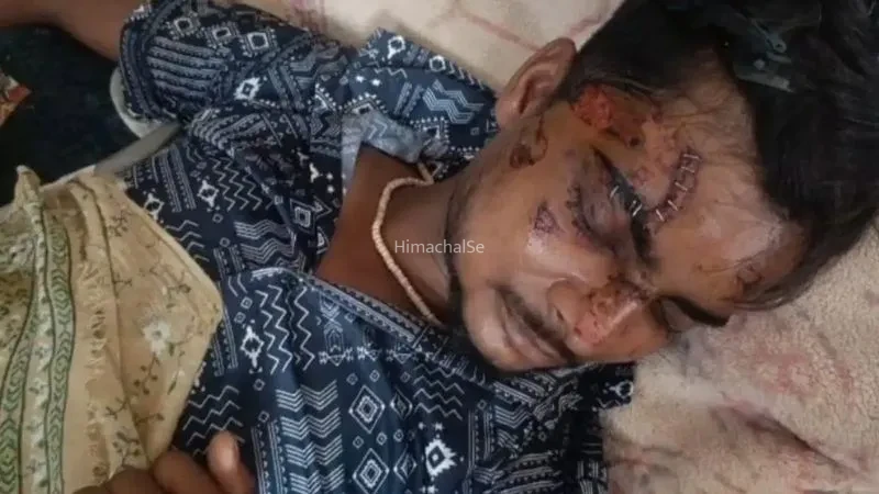 ​​​जेब में रखा​​​ Motorola​​ फोन अचानक फटा, बुरी तरह झुलसा युवक, डॉक्टर ने टांकों की जगह लगा दिए स्टेपलर पिन​​​​