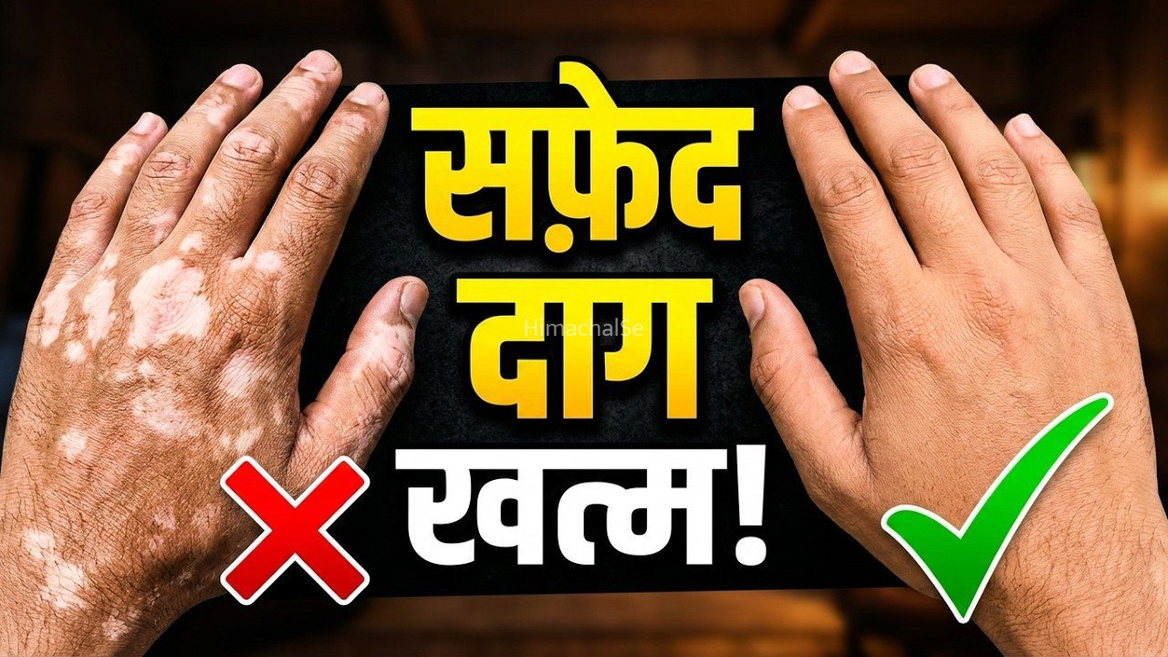 चाहे 40 साल पूराना ही सफ़ेद दाग क्यों ना हो, ये अद्भुत सप्त तेल उम्मीद की आखिरी किरण है, जरूर पढ़े और शेयर करे​​​​​​​​​​​​​​​​​​​​