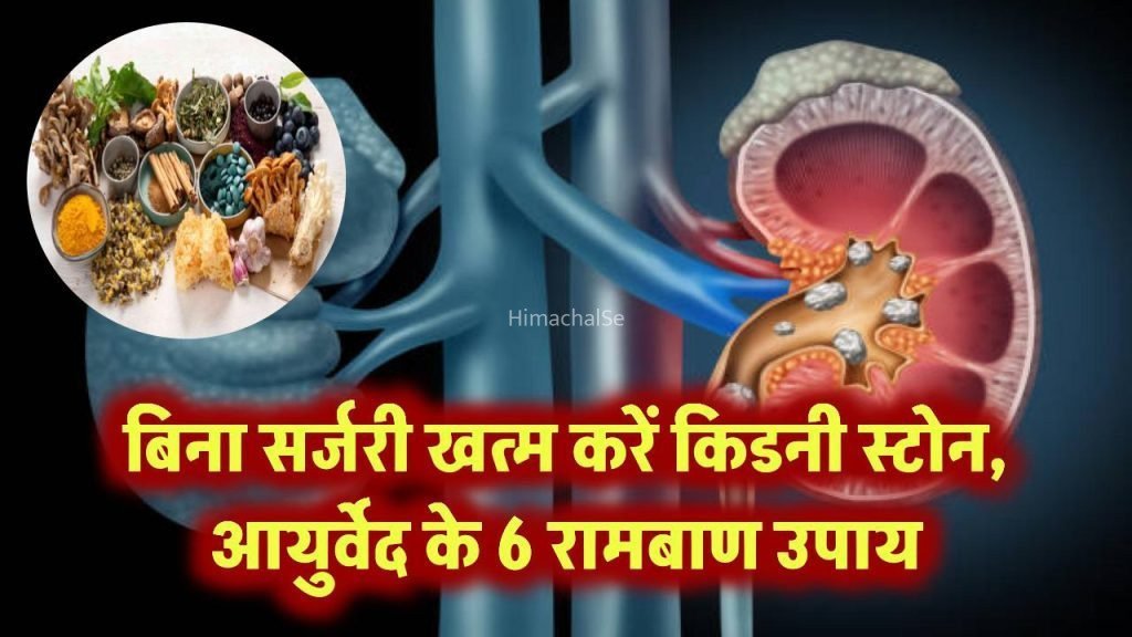 ​​बिना सर्जरी घुल जाएंगे किडनी स्टोन! जानिए आयुर्वेद डॉक्टर के 6 रामबाण उपाय