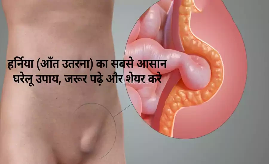 हर्निया (आंत उतरना) का सबसे आसान घरेलू उपाय, डॉक्टर के पास जाने से पहले जान लें इस देसी उपाय के बारे में