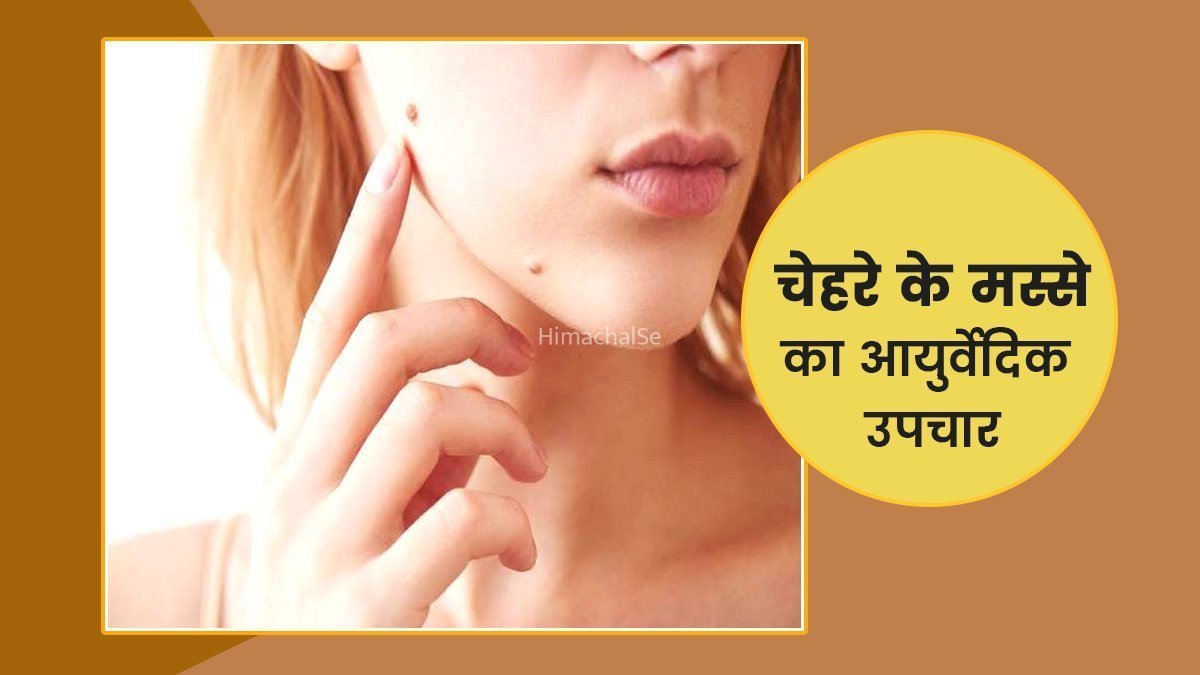 क्या आप भी मस्सों से परेशान है तो अपनाएं ये घरेलू नुस्खे, जानिए मस्सों को ठीक करने के आयुर्वेदिक उपचार
