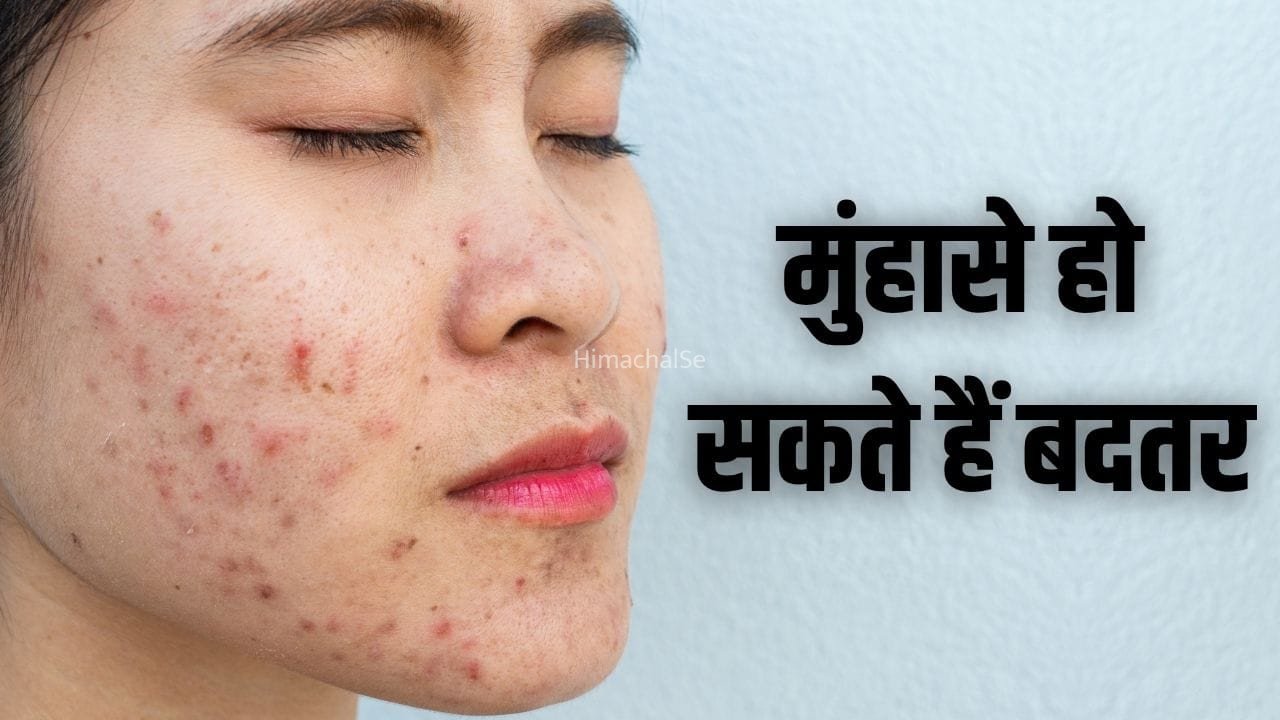 मुंहासों की समस्या हो रही ट्रिगर, आपकी रोज की ये 5 गलतियां हो सकती हैं वजह​