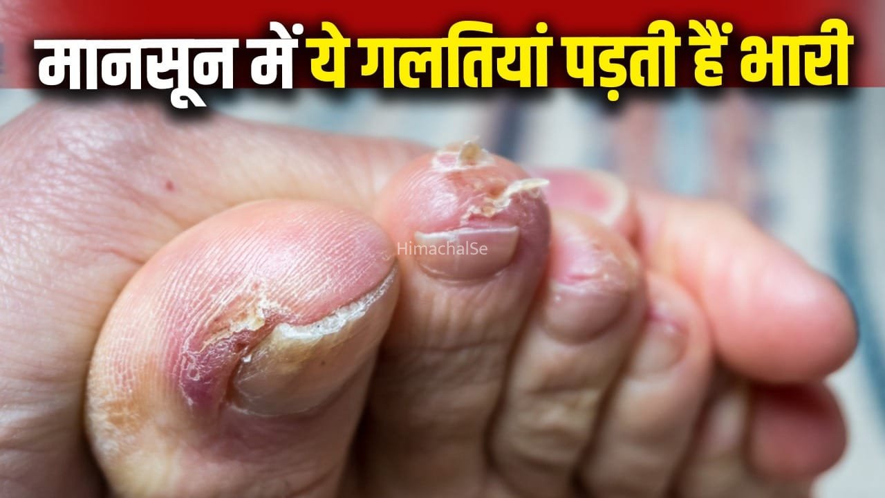 पैरों में हो सकता है फंगल इंफेक्शन, मानसून में ये गलतियां करने से बचें​